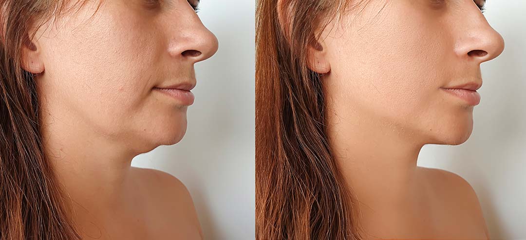 How Can I Get Rid of My Double Chin?