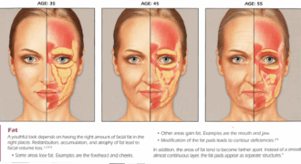 Sculptra