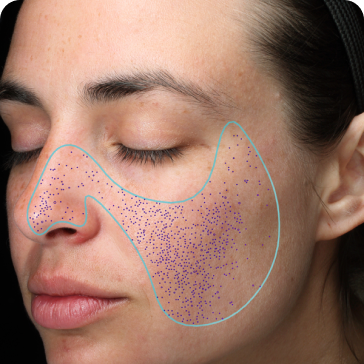 VISIA Skin Analysis 1 VISIA Skin Analysis