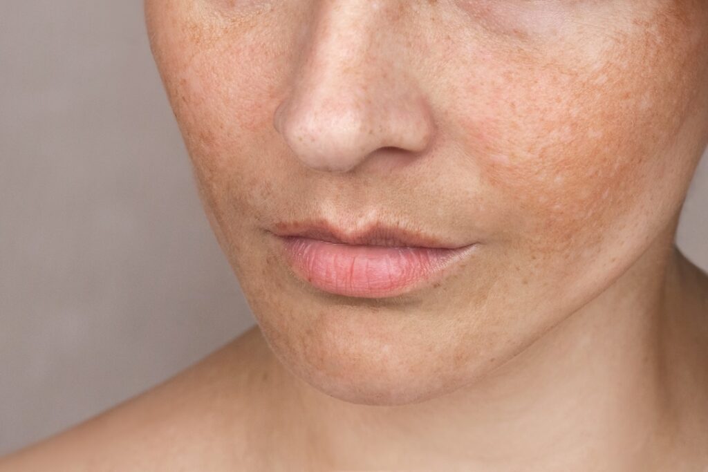 Skin rejuvenation with IPL light therapy for clearer, brighter complexion